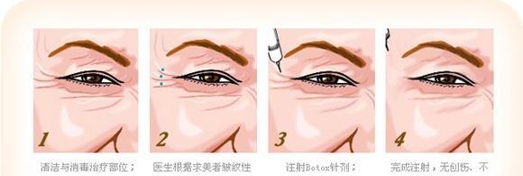 改善鱼尾纹的终极方法（有效消除鱼尾纹）  第1张